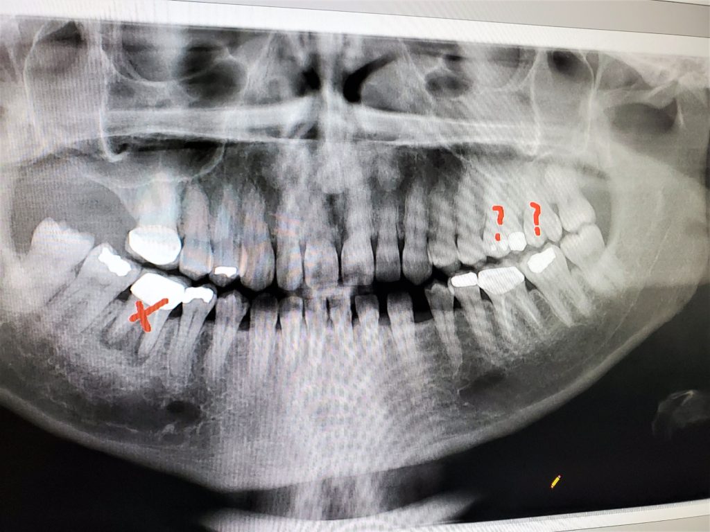Dental x-rays